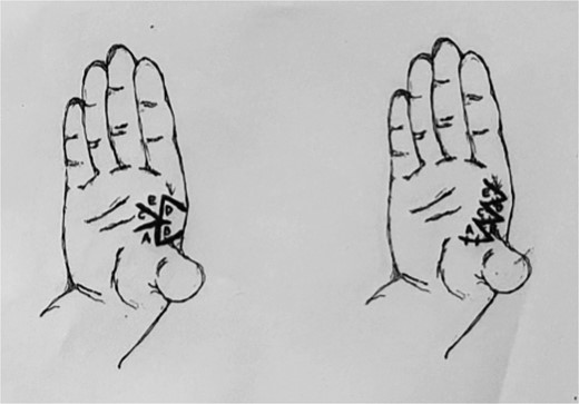 Incisions for webspace release with five-flap z-plasty showing initial and final positions of flaps A–E. Note all limbs are of equal length, except, the central limb (scar contracture), which is double the others. Note the addition of flap C, which is a y-to-v advancement flap.