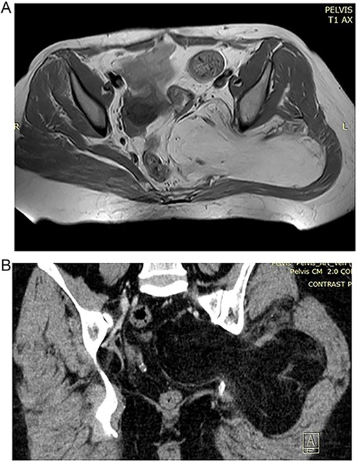 (A) Preoperative MRT image showing lipoma in the pelvic region. (B) Preoperative CT of the 57 year old patient with high signal of the lipomatous lesion.