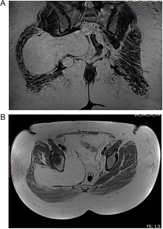 (A) Preoperative CT of the 55 year old patient with lipoma in the pelvic region. (B) Preoperative CT of the 55 year old patient with lipoma in the pelvic region.