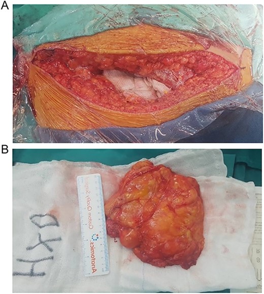 (A) Transgluteal approach used for excision of the lipomatosus lesion. (B) Complete resection of the lesions and intraoperative measurement of its sizes.