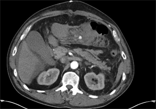 CT angiogram performed on 5th postoperative day, demonstrating a small false aneurysm (1.2 × 1 × 1 cm) arising from the marginal artery of Drummond.
