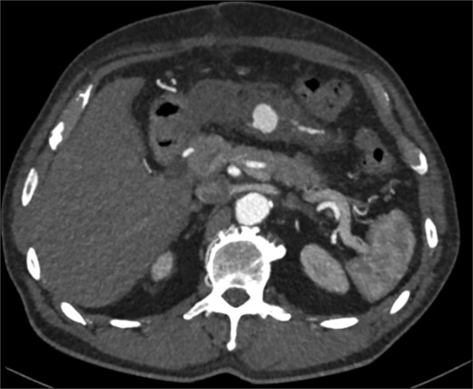 Interval CT angiogram demonstrating enlargement of the false aneurysm (2.1 × 1.8 × 1.8 cm).
