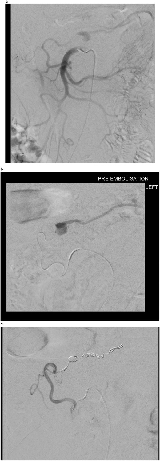 (a) Digital subtraction angiogram (DSA) image taken from the SMA, demonstrating the pseudoaneurysm arising from the marginal artery of Drummond. (b) Microcatheter within the marginal artery of Drummond demonstrating the pseudoaneurysm. (c) Post-embolization image with four microcoils and successful occlusion of the pseudoaneurysm.