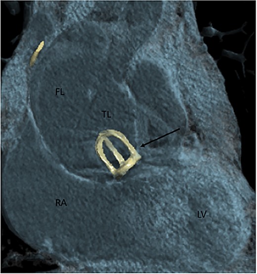 Contrast-enhanced CT aortography coronal plane in volume rendering technique reconstruction. Stanford A dissection distal to artificial caged-ball (thin arrow) mechanical valve. FL, false lumen; TL, true lumen; RA, right atrium; LV, left ventricle.