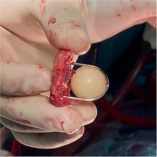 Intraoperative photography showing the excised fully functional Starr–Edwards caged-ball mechanical prosthesis.