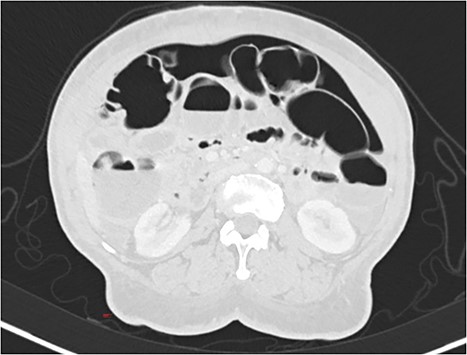 CT scan (axial) showing pneumoperitoneum.