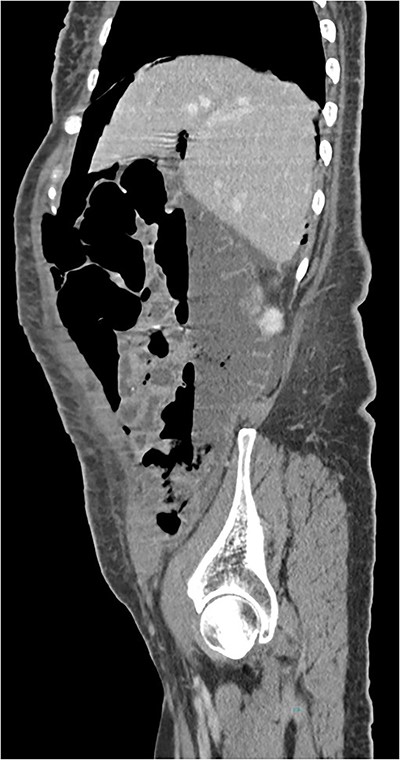CT scan (sagittal) showing pneumoperitoneum.