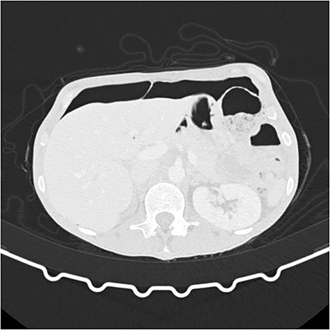 CT scan (axial) showing pneumoperitoneum.