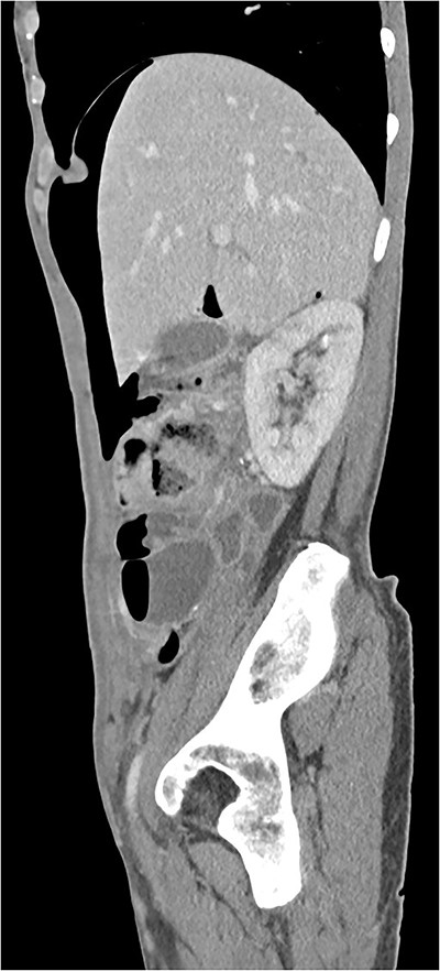CT scan (sagittal) showing pneumoperitoneum.