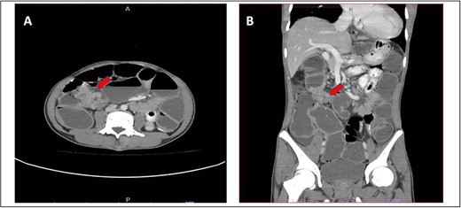 (A) Axial view and (B) coronal view of computed tomography showed short segment thickening of proximal transverse colon (red arrow) with dilatation of bowel.