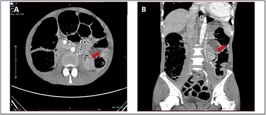 (A) Axial view and (B) coronal view of computed tomography showed presence of doughnut sign at left lumbar region suggestive of jejunojejunal intussusception (red arrow).