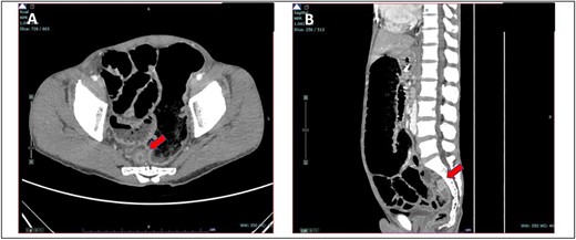 (A) Axial view and (B) sagittal view of computed tomography showed short segment circumferential enhancing bowel wall thickening at rectosigmoid region causing intraluminal obstruction (red arrow).
