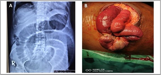 (A) Plain abdominal radiograph showed dilated small bowel (B) intraoperative finding of unhealthy sloughy small bowel segment in the hernia sac and pus was present.