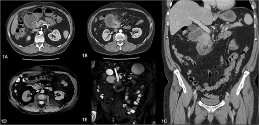 Radiological images of annular pancreas. (A–C) Computerized tomography images showing duodenal obstruction with a transition point at level of pancreatic head with periduodenal fat stranding and duodenal wall thickening, with impression of enhancing pancreatic tissue lateral to duodenum at this site. (C, D) Magnetic resonance cholngiopancreatography images showing an abrupt transition in the caliber of the second part of the duodenum by an obstructive periampullary lesion, the annular pancreas.