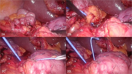 (A–D) Sequential depiction of the plane between annular pancreas and duodenum being defined using Maryland grasper (A, B) and silicone vessiloop (B–D).