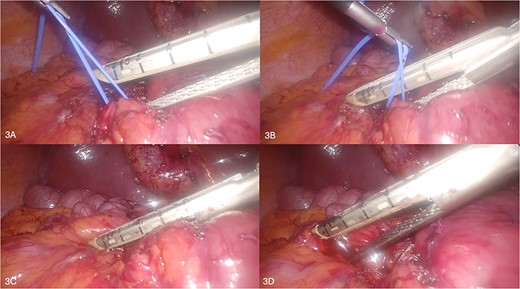 (A–D) Sequential depiction of the division of annular pancreas using laparoscopic stapler device.