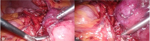 (A, B) Successfully transected annular pancreas above duodenum.