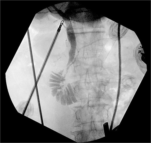 Intraoperative cholangiogram showing pancreaticobiliary malunion with the bile duct entering the main pancreatic duct proximal to the ampulla.
