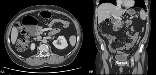 (A, B) A repeat CT at 4 months showing improvement of the gastric and duodenal distension proximal to the previous transition point and resolution of the periduodenal fat stranding and duodenal wall thickening.