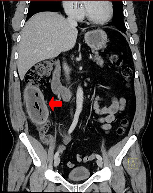 A coronal CT view reveals an oval mass in the right iliac fossa. The mass has a thick, edematous wall and contains fluid and gas. Extensive fat stranding is visible, but no free fluid or bowel dilation is noted.