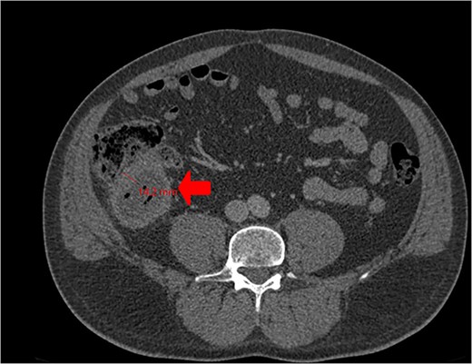 Cross-sectional CT view shows the mass measuring 13 × 5.2 cm with significant wall thickening measuring 14.2 mm and fat stranding. The contents are a mixture of fluid and gas, consistent with appendicitis.