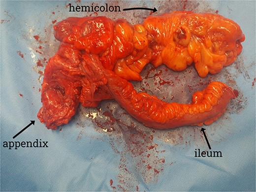 Gross specimen showing the terminal ileum, cecum, appendix, and ascending colon. The appendix is visible near the base of the cecum.