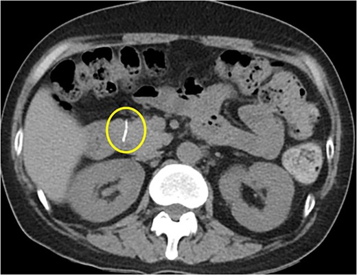 Abdominal CT scan showing a 1.7-cm linear high-density foreign body penetrating the anterior aspect of the head of pancreas.
