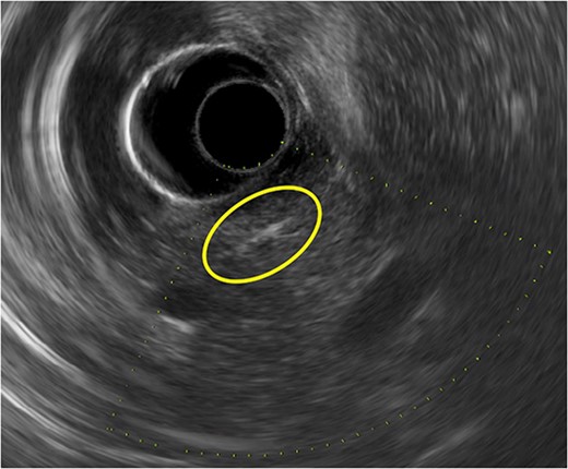 A linear and straight highly echogenic substance is seen in the parenchyma of the pancreatic head on endoscopic ultrasonography.