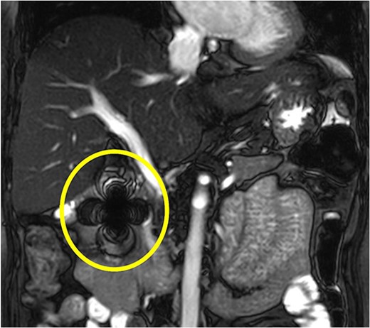 MRCP shows a severe ferromagnetic artifact in the pancreatic head and the second part of the duodenum, suggesting the presence of a metal foreign body in that area.