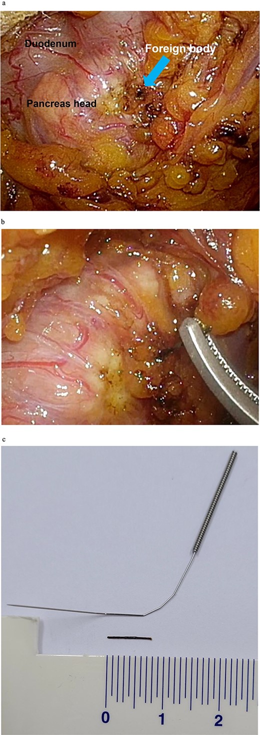 Intraoperative images showing the (a) identification of the foreign body, (b) removal of the foreign body, and (c) comparison of the foreign body with an intact acupuncture needle.