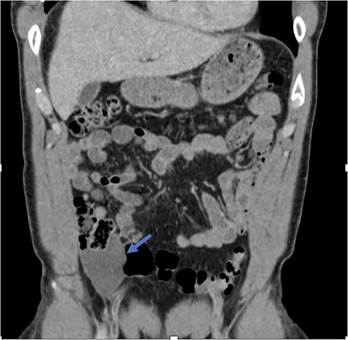 Fluid collection is present in the expected location of the appendix that measures 5.2 × 2.9 × 6.6 cm (blue arrow). The appendix is not seen as a separate and distinct structure.