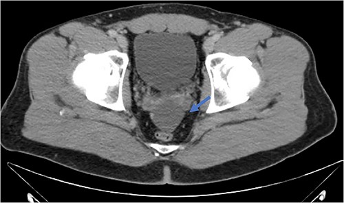 Fluid collection is present in the cul-de-sac that measures 5.8 × 4.8 × 2.9 cm (blue arrow).