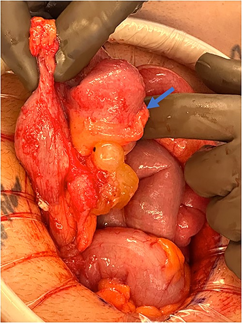 Perforated mucinous mass at the base of the appendix (blue arrow).