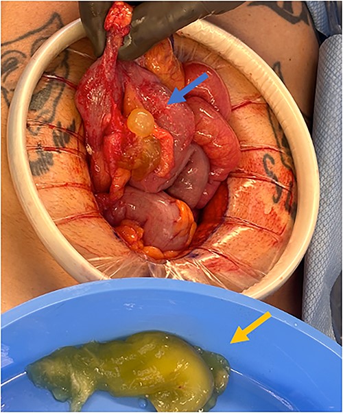 Perforated mucinous mass at the base of the appendix (blue arrow) and mucin collection at the region of the appendix (yellow arrow).