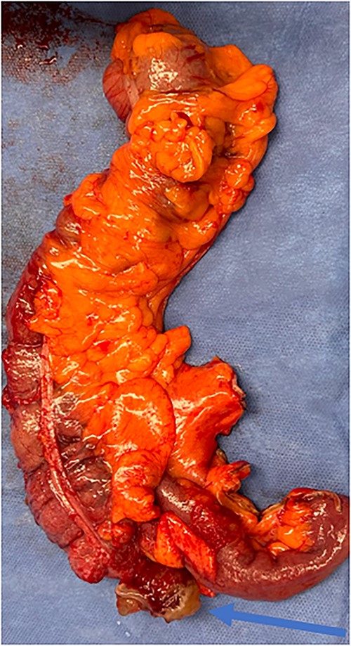 Specimen including terminal ileum, ascending colon containing the perforated mucinous mass at the base of the cecum (blue arrow).