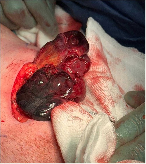 Left femoral hernia containing ischaemic small bowel.