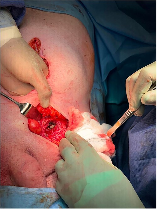 Infra umbilical midline laparotomy incision.