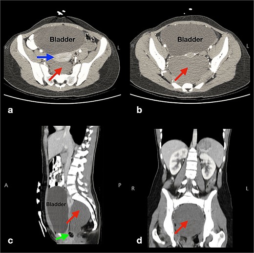 Multi-plane (a,b: axial and c: sagittal, d: coronal) abdominopelvic computed tomography scans displaying a well-defined cystic lesion, with fluid attenuation, and of biloculated nature measuring 11 × 10.5 × 8 cm (arrows in pictures a, b, c, d). This lesion has no soft tissue components or calcifications and is located in the presacral region near the sigmoid colon, rectum (arrow in picture c), and the uterus anteriorly (horizontal arrow in picture a), and both iliac vessels laterally. Also, the bladder is severely distended (pictures a, b, c).