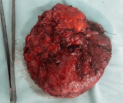 Photograph of the excised mass.