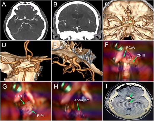 Preoperative imaging, surgical images, and postoperative tomography (illustrative case II). (A–B) CTA revealed saccular aneurysms located in the anterior communicating artery and BAA; (C–E) Three-dimensional image reconstruction showed a bilobed anterior communicating aneurysm of 4.3 × 6.8 mm and a saccular BAA of 3.5 × 5.2 mm (green arrows); (F–H) The operative field depicted the corridors along with major structures (i.e. PCoA: posterior communicating artery, CN III: cranial nerve III, L P1: left P1 segment, and R P1: right P1 segment) that were carefully handled to access the BAA (green arrows); (I) Postoperative head tomography showed the placement of clips in the aneurysm necks (green arrows). BAA: basilar apex aneurysm; CTA: computed tomography angiography.