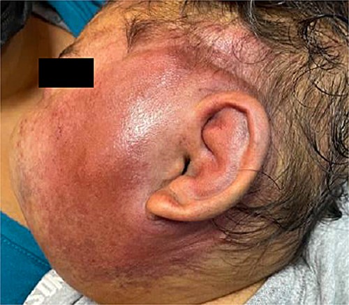 Hemangioma of ~15 × 20 cm, on left hemiface.