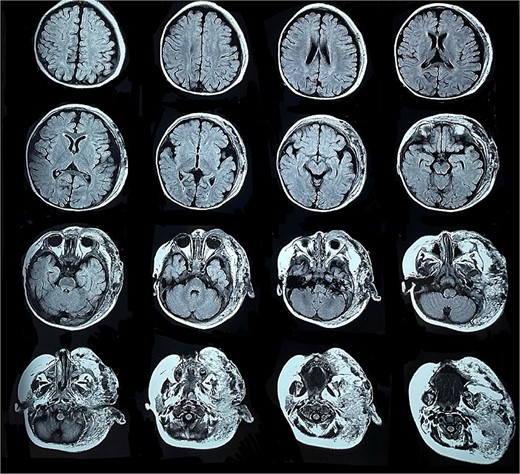 Angioresonance with evidence of a hemangioma on left hemiphase (cross-sectional).