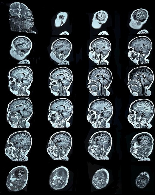 Angioresonance with evidence of a hemangioma on left hemiphase (coronal plane).