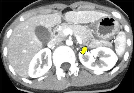 Contrast-enhanced CT on admission. Linear areas with poor contrast in the pancreatic body and increased peripancreatic fatty tissue density were observed.