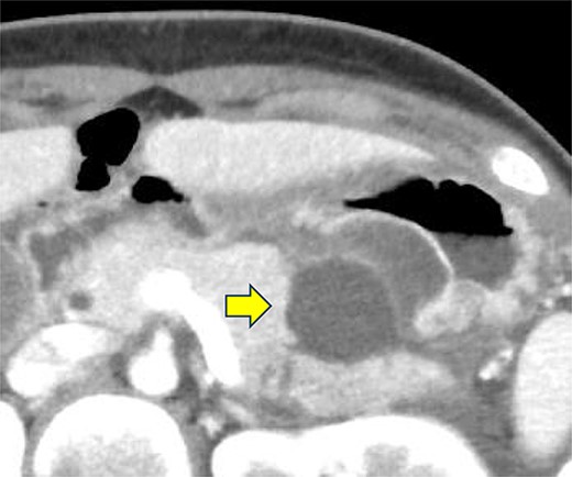 Contrast-enhanced CT of the abdomen on the fourth day. Fluid accumulation (pancreatic pseudocyst) was observed, primarily located on the ventral pancreatic body and extending toward the vicinity of the spleen, along with edematous thickening of the adjacent gastric posterior wall.