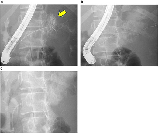 ERP and EPS on the fourth day. (a) Leakage of the contrast medium was observed in the pancreatic body, leading to the diagnosis of grade III pancreatic injury. (b) The cannula had difficulty passing through the injury site; however, the guidewire was observed to have passed beyond the pancreatic duct injury site at the pancreatic tail. (c) A 5 Fr-5 cm EPS was placed in the region of the pancreatic head.