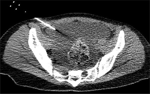 CT of the pelvic region on the fourth day. An increase in ascitic fluid was observed. CT-guided abdominal drainage was performed, and a 10 Fr drainage tube was placed.