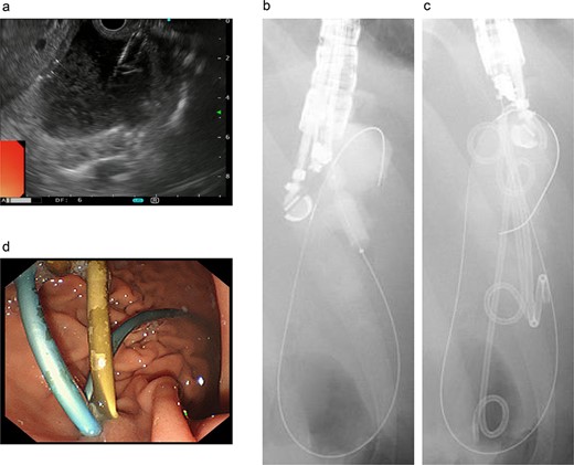 Endoscopic ultrasound-guided transgastric pseudocyst drainage. (a) Endoscopic ultrasound-guided puncture of the pseudocyst. (b) The posterior wall of the stomach was punctured, and the puncture hole was dilated with a balloon. (c) Placement of three tube stents through the puncture hole. (d) Placement of three tube stents of 7 Fr-7 cm and 7 Fr-4 cm × 2.