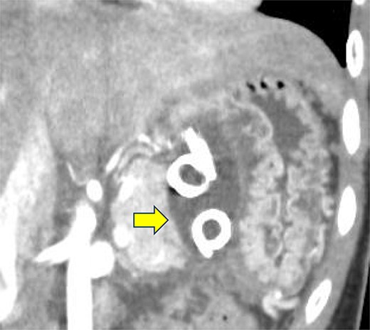 Contrast-enhanced CT on the 12th day. The pseudocyst in the omental bursa had shrunk. The arrow indicates the pseudocyst.