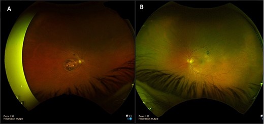 Optomap fundus photos of the patient. (A) Right eye with macular atrophy. (B) Left eye with macular subretinal fluid (SRF) and retinal pigment epithelial (RPE) detachment at the superior arcade.